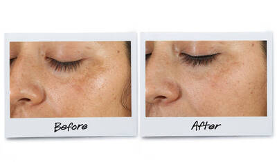 Alt text: A comparison of a person's skin condition before and after treatment, with noticeable improvements in skin clarity and texture. The left image is labeled "Before," and the right image is labeled "After."