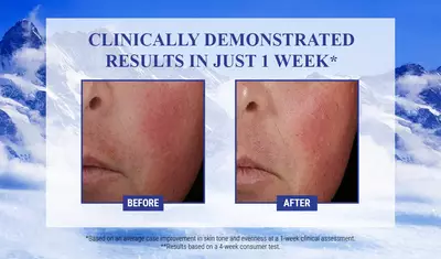 Alt text: Comparison images showing skin before and after treatment, with visible improvement in tone and evenness, labeled "Before" and "After."