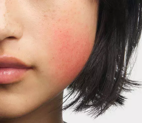De wang van de vrouw vertoont roodheid en blozen, typisch voor rosaceasymptomen