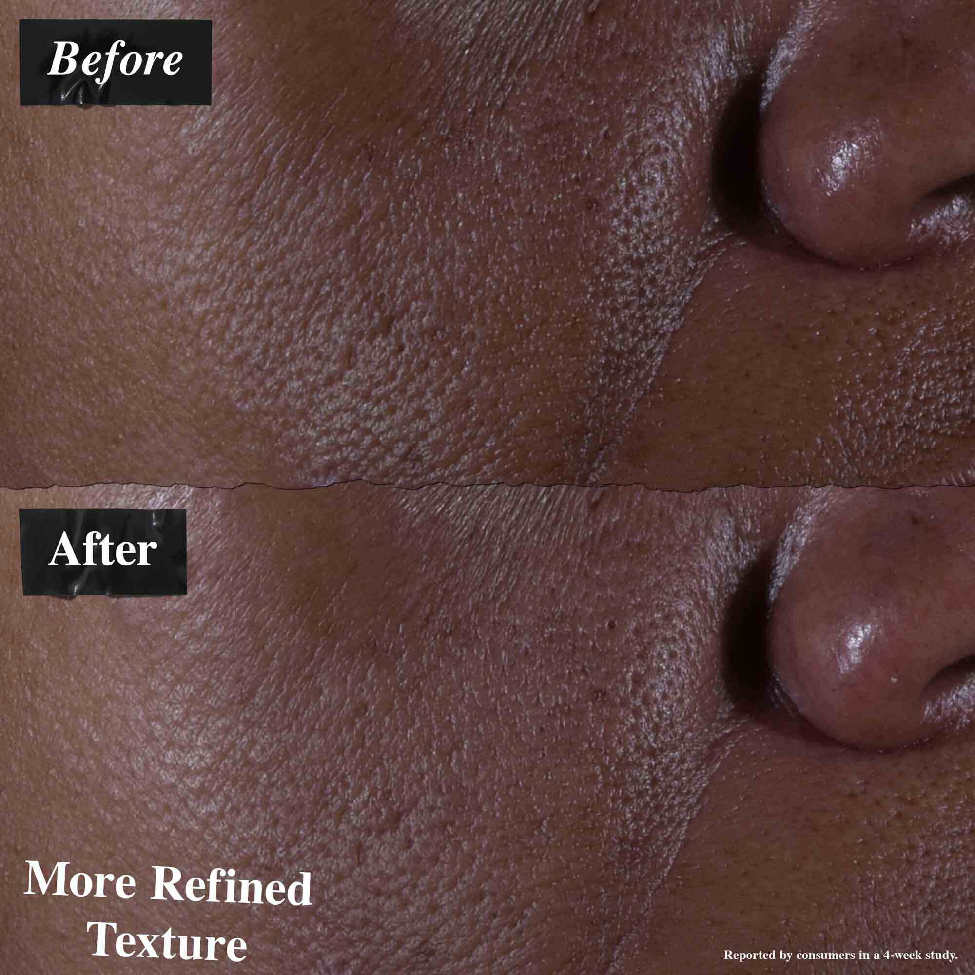 Een voor-en-na vergelijking die huid toont behandeld met Ultra Pure 9.8% Glycolic Acid Serum. De "voor"-afbeelding toont een ongelijkmatige textuur, terwijl de "na"-afbeelding een verfijndere textuur toont.