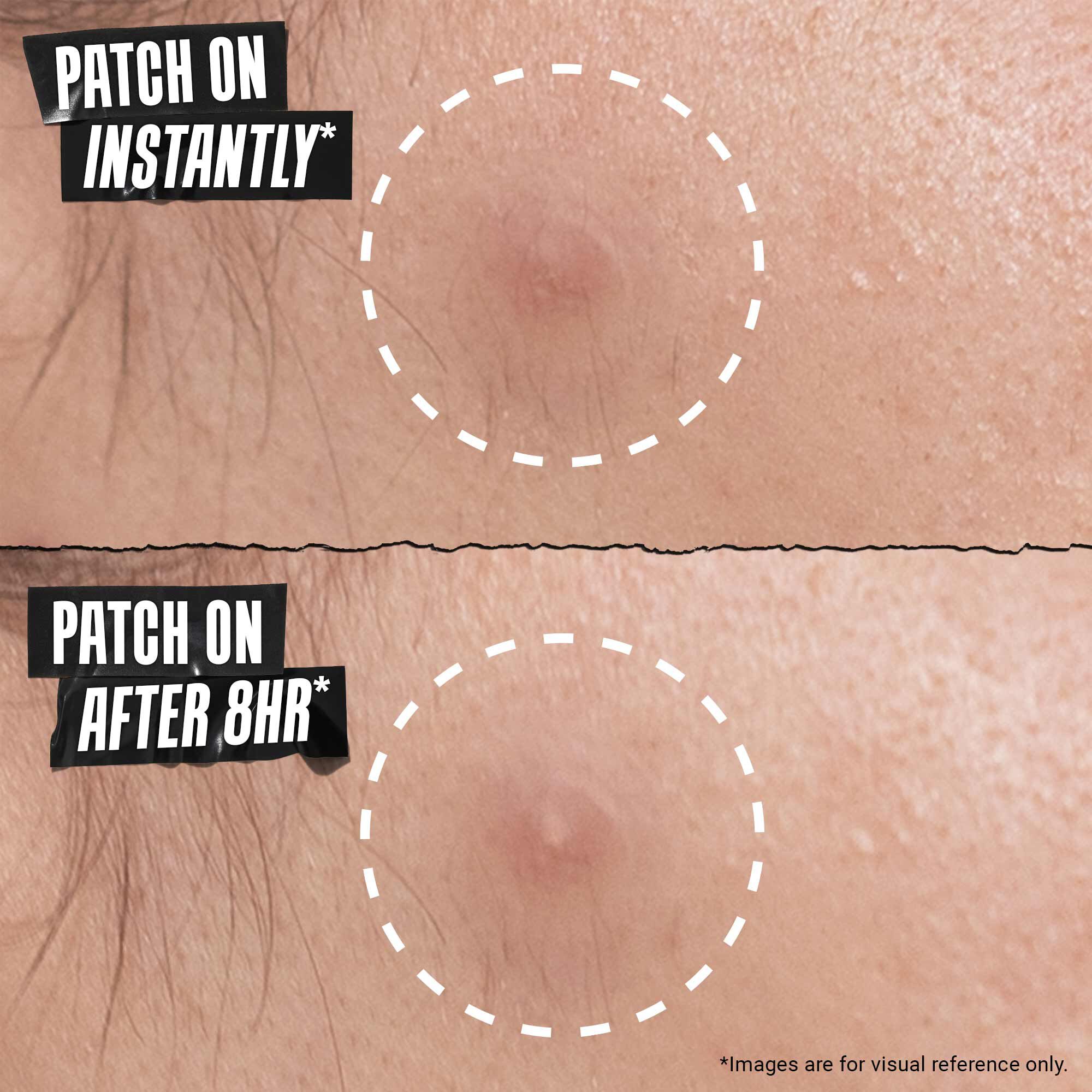 Before and after comparison of a blemish with "Patch On Instantly" and "Patch On After 8HR," demonstrating the patch's effectiveness over time.