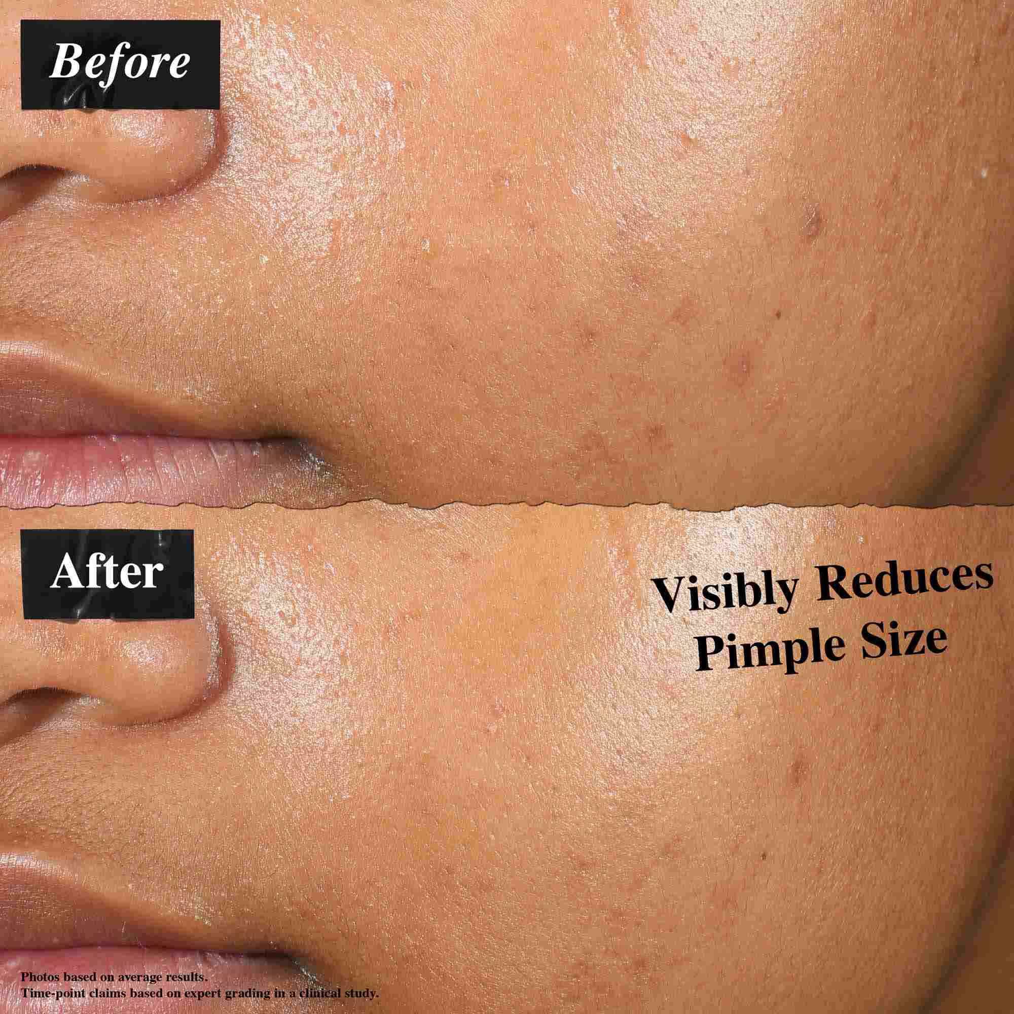 Een voor-en-na vergelijking die huid toont behandeld met Truly-Targeted Blemish-Clearing Solution. De "voor" afbeelding toont zichtbare puistjes, terwijl de "na" afbeelding verminderde grootte van puistjes toont.